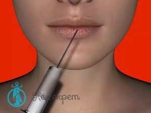 Колят ли ботокс в носогубные складки